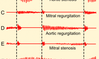 Phonocardiograms from normal and abnormal heart sounds