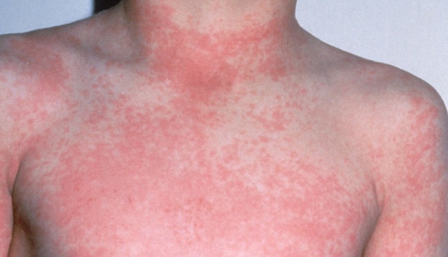 What is Scarlet Fever? Scarlet Fever Causes and Symptoms