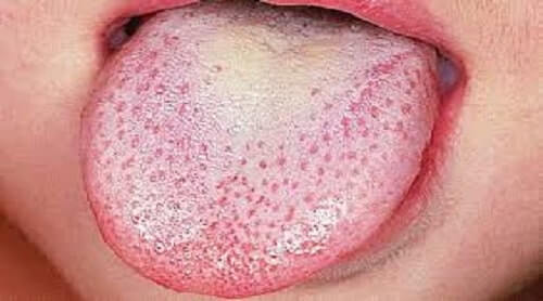 What is Scarlet Fever? Scarlet Fever Causes and Symptoms