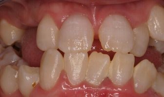 Teeth Diseases and Disorders - (Causes and Treatment)