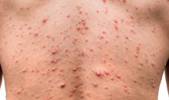What is Chickenpox? What are the symptoms, causes and treatments