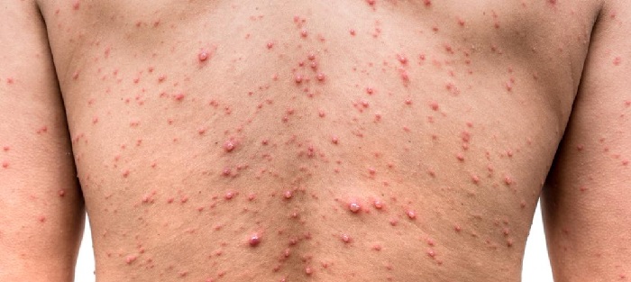 What is Chickenpox? What are the symptoms, causes and treatments