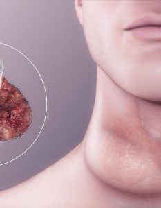 Goiter Causes Symptoms and Types & What are the types of Goiter disease?