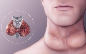 Goiter Causes Symptoms and Types & What are the types of Goiter disease?