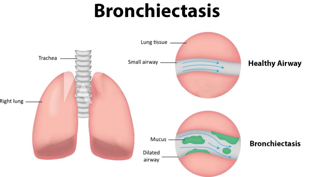 What Are The Causes and Symptoms Of Bronchiectasis?