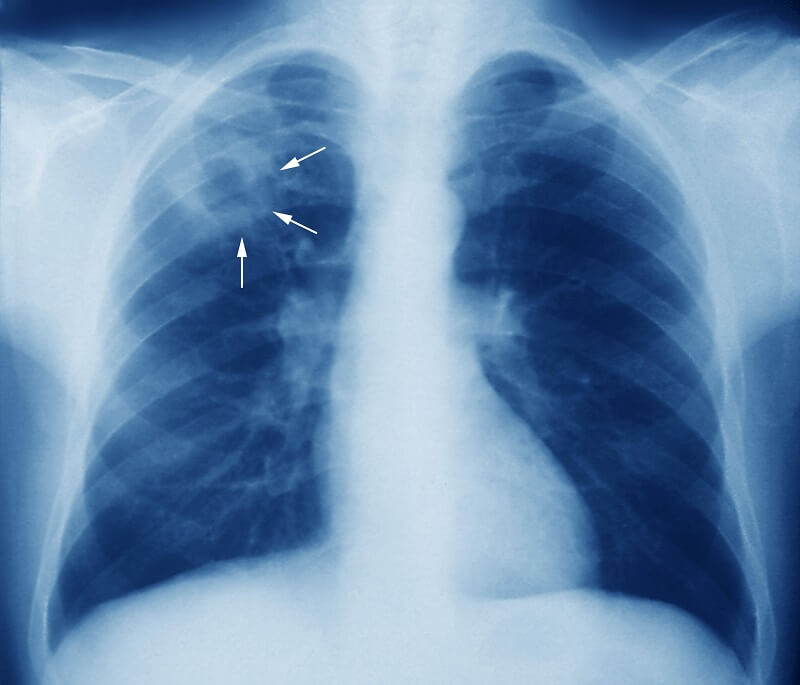 Tuberculosis Causes and Symptoms - Complications of Tuberculosis