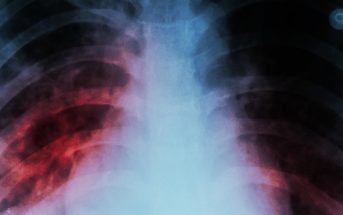 Tuberculosis Causes and Symptoms - Complications of Tuberculosis