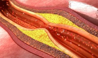 What is Atherosclerosis? - Atherosclerosis Symptoms and Causes