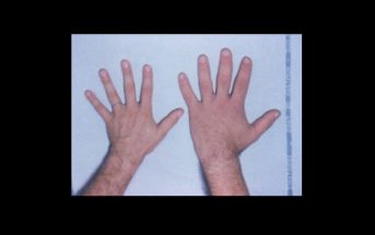What is Acromegaly? - What are the Symptoms? How is it treated?
