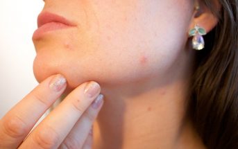 Acne: Causes, Prevention, Treatment and Tips