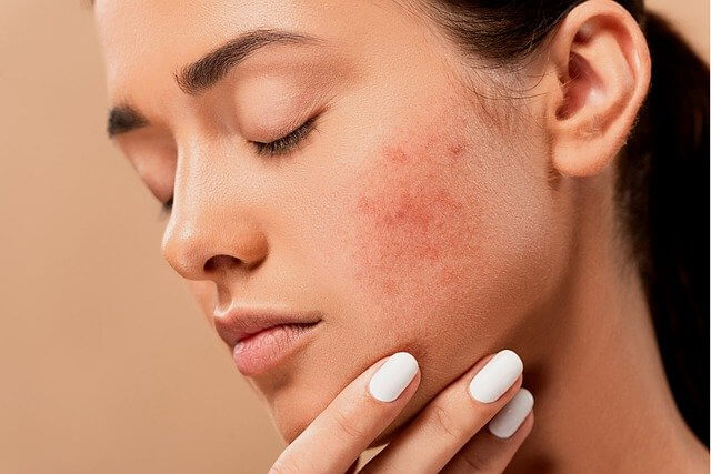 Acne: Causes, Prevention, Treatment and Tips