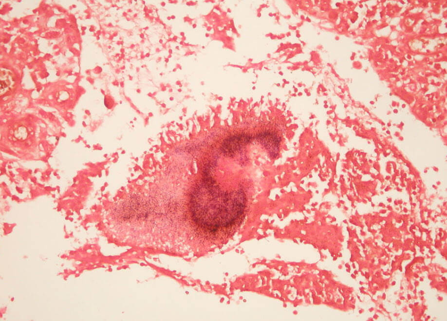 Actinomycosis Gram stain