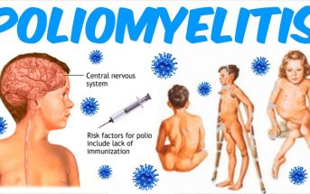 Use Poliomyelitis in a Sentence - How to use "Poliomyelitis" in a sentence