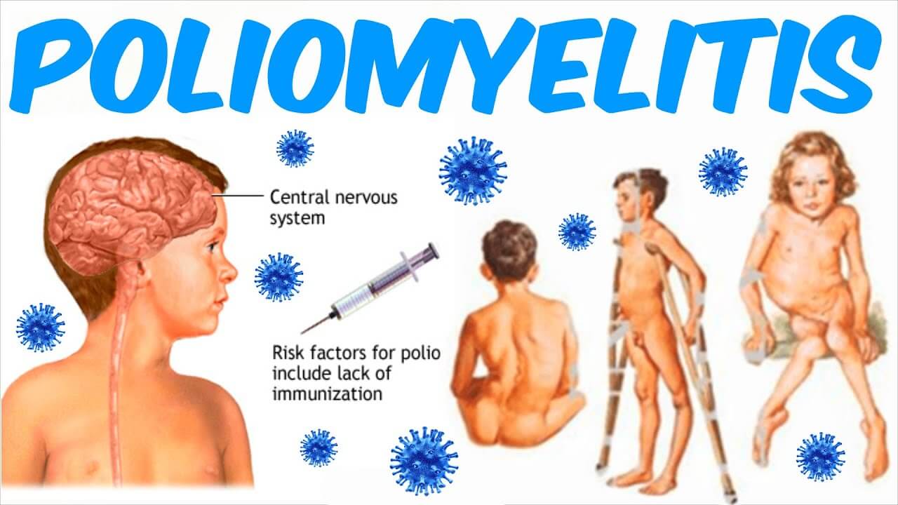 Use Poliomyelitis in a Sentence - How to use "Poliomyelitis" in a sentence