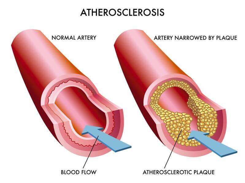 What are the Causes and Symptoms of Arteriosclerosis?